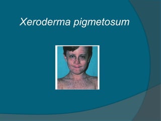 Xeroderma pigmetosum
 