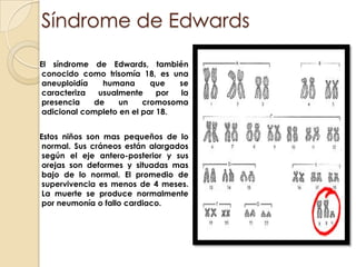 Síndrome de Edwards    El síndrome de Edwards, también conocido como trisomía 18, es una aneuploidía humana que se caracteriza usualmente por la presencia de un cromosoma adicional completo en el par 18. 	     Estos niños son mas pequeños de lo normal. Sus cráneos están alargados según el eje antero-posterior y sus orejas son deformes y situadas mas bajo de lo normal. El promedio de supervivencia es menos de 4 meses. La muerte se produce normalmente por neumonía o fallo cardiaco.