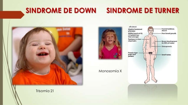 El Sindrome De Down Es Una Monosomia Y