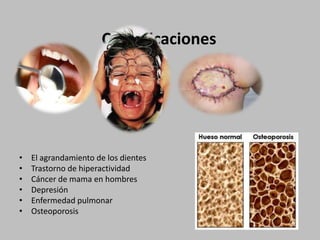 ComplicacionesEl agrandamiento de los dientes Trastorno de hiperactividadCáncer de mama en hombresDepresiónEnfermedad pulmonarOsteoporosis