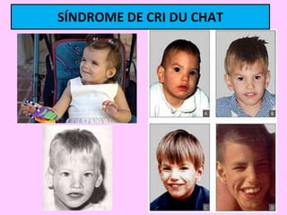 SÍNDROME DE CRI DU CHAT

 