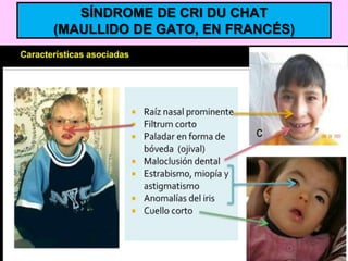 SÍNDROME DE CRI DU CHAT
(MAULLIDO DE GATO, EN FRANCÉS)

 