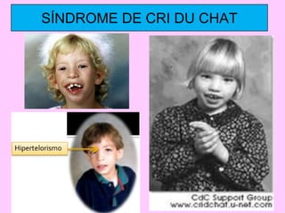 SÍNDROME DE CRI DU CHAT

 