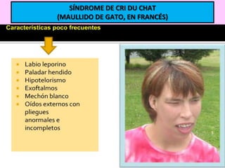 SÍNDROME DE CRI DU CHAT
(MAULLIDO DE GATO, EN FRANCÉS)

 