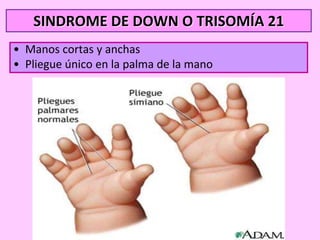 SINDROME DE DOWN O TRISOMÍA 21
• Manos cortas y anchas
• Pliegue único en la palma de la mano

 