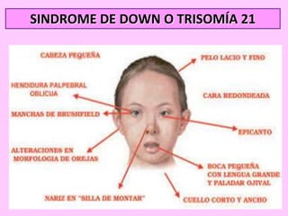 SINDROME DE DOWN O TRISOMÍA 21

 