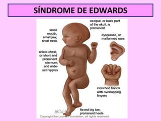 SÍNDROME DE EDWARDS

 