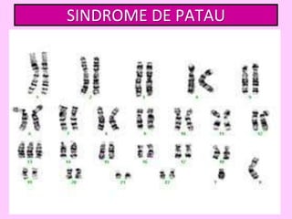 SINDROME DE PATAU

 