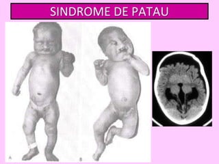 SINDROME DE PATAU

 