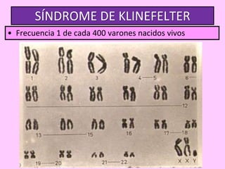 SÍNDROME DE KLINEFELTER
• Frecuencia 1 de cada 400 varones nacidos vivos

 