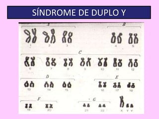 SÍNDROME DE DUPLO Y

 