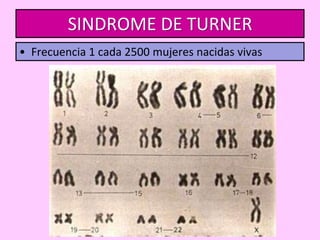 SINDROME DE TURNER
• Frecuencia 1 cada 2500 mujeres nacidas vivas

 