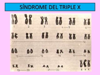 SÍNDROME DEL TRIPLE X

 