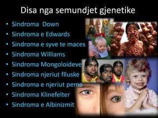 Disa nga semundjet gjenetike
• Sindroma Down
• Sindroma e Edwards
• Sindroma e syve te maces
• Sindroma Williams
• Sindroma Mongoloideve
• Sindroma njeriut flluske
• Sindroma e njeriut peme
• Sindroma Klinefelter
• Sindroma e Albinizmit
 