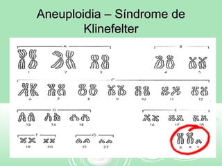 Aneuploidia – Síndrome deAneuploidia – Síndrome de
KlinefelterKlinefelter
 