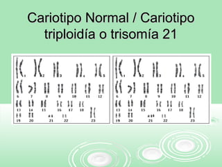 Cariotipo Normal / CariotipoCariotipo Normal / Cariotipo
triploidía o trisomía 21triploidía o trisomía 21
 