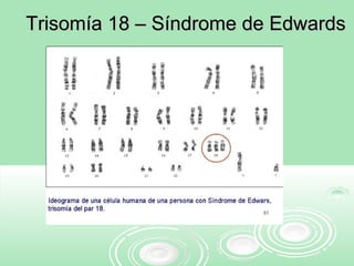 Trisomía 18 – Síndrome de EdwardsTrisomía 18 – Síndrome de Edwards
 