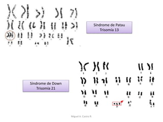 Síndrome de Patau
Trisomía 13
Síndrome de Down
Trisomía 21
Miguel A. Castro R.
 