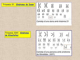 Trisomia 21. Síndrome de Down
Cariotip d’una dona amb trisòmia 21
Trisomia XXY. Síndrome
de Klinefelter
Cariotip d’una persona amb síndrome
de Klinefelter, (XXY)
 
