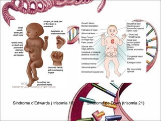 Sindrome d’Edwards ( trisomia 18) Sindrome de Down (trisomia 21)
 