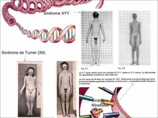 Sindrome de Turner (X0)
Sindrome de
Klinefelter
(XXY)
Sindrome XYY
 