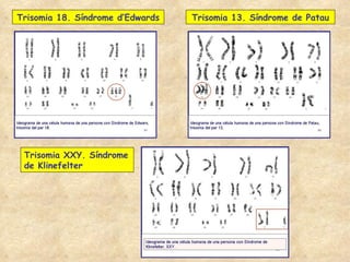 Trisomia 18. Síndrome d’Edwards Trisomia 13. Síndrome de Patau Trisomia XXY. Síndrome de Klinefelter 