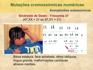 Mutaç ões cromossómicas numéricas Aneuploidias autossómicas S índrome de Down  -  Trissomia 21   (47,XX + 21 ou 47,XY + 21)  Baixa estatura, face achatada, olhos obl íquos, língua grande, malformações cardíacas atrasos mentais. 