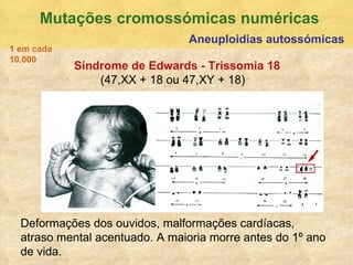 Mutaç ões cromossómicas numéricas Aneuploidias autossómicas S índrome de Edwards - Trissomia 18   (47,XX + 18 ou 47,XY + 18) Deformaç ões dos ouvidos, malformações cardíacas,  atraso mental acentuado. A maioria morre antes do 1º ano  de vida. 1 em cada 10.000 
