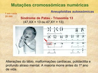 Mutaç ões cromossómicas numéricas Aneuploidias autossómicas S índrome de Patau - Trissomia 13   (47,XX + 13 ou 47,XY + 13) Alteraç ões do lábio, malformações cardíacas, polidactilia e profundo atraso mental. A maioria morre antes do 1º ano  de vida. 1 em cada 20.000 