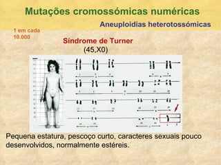 Mutaç ões cromossómicas numéricas Aneuploidias heterotossómicas S índrome de Turner   (45,X0) Pequena estatura, pescoço curto, caracteres sexuais pouco desenvolvidos, normalmente est éreis. 1 em cada 10.000 