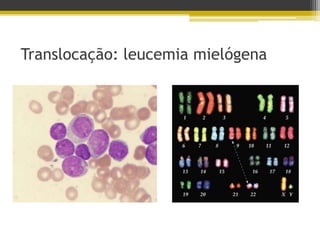 Translocação: leucemia mielógena