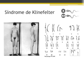 Síndrome de Klinefelter
