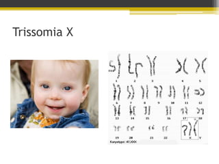 Trissomia X