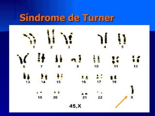 Síndrome de Turner 
