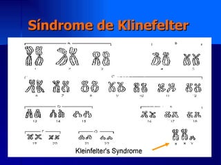 Síndrome de Klinefelter 