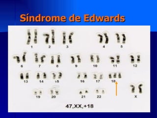 Síndrome de Edwards 