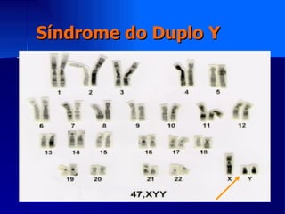 Síndrome do Duplo Y 