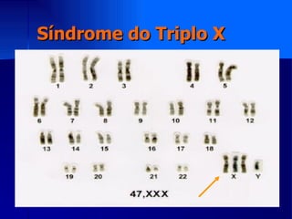 Síndrome do Triplo X 