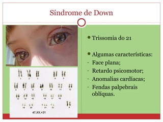 Síndrome de Down


         Trissomia do 21


         Algumas características:
         - Face plana;
         - Retardo psicomotor;
         - Anomalias cardíacas;
         - Fendas palpebrais
          oblíquas.
 