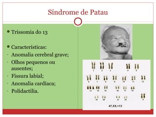 Síndrome de Patau

 Trissomia do 13


 Características:
- Anomalia cerebral grave;
- Olhos pequenos ou
  ausentes;
- Fissura labial;
- Anomalia cardíaca;
- Polidactilia.
 