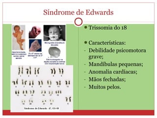 Síndrome de Edwards
           Trissomia do 18


           Características:
           - Debilidade psicomotora
               grave;
           -   Mandíbulas pequenas;
           -   Anomalia cardíacas;
           -   Mãos fechadas;
           -   Muitos pelos.
 
