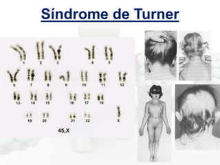 Síndrome de Turner

 