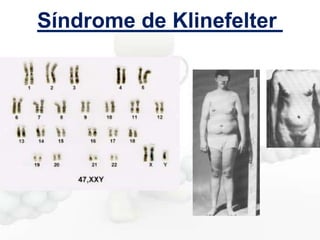 Síndrome de Klinefelter

 