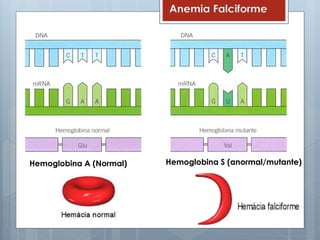 Anemia Falciforme
Hemoglobina A (Normal) Hemoglobina S (anormal/mutante)
 