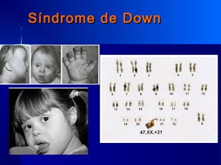 Síndrome de DownSíndrome de Down
 