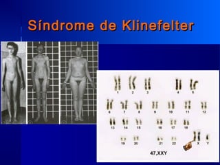 Síndrome de KlinefelterSíndrome de Klinefelter
 