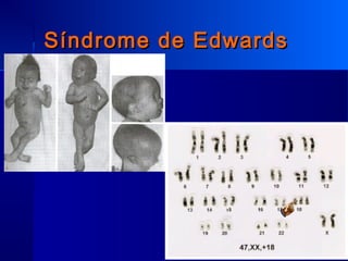 Síndrome de EdwardsSíndrome de Edwards
 