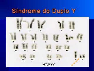 Síndrome do Duplo YSíndrome do Duplo Y
 