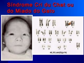 Síndrome Cri du Chat ouSíndrome Cri du Chat ou
do Miado do Gatodo Miado do Gato
 