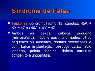 Síndrome de EdwardsSíndrome de Edwards
 TrissomiaTrissomia do cromossomo 18,do cromossomo 18,
cariótipo 45A + XX = 47 ou ...
